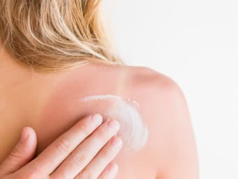 Scottatura solare: cosa fare? Rimedi naturali o creme all’aloe vera alleviano il bruciore