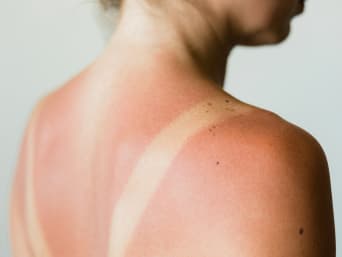 Sonnenbrand behandeln: Pflegende After-Sun-Lotionen oder Cremes mit Aloe vera wirken lindernd.