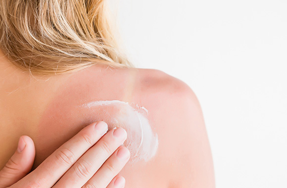 Soulager un coup de soleil : les remèdes maison ou de la crème avec de l’aloe vera soulagent la douleur